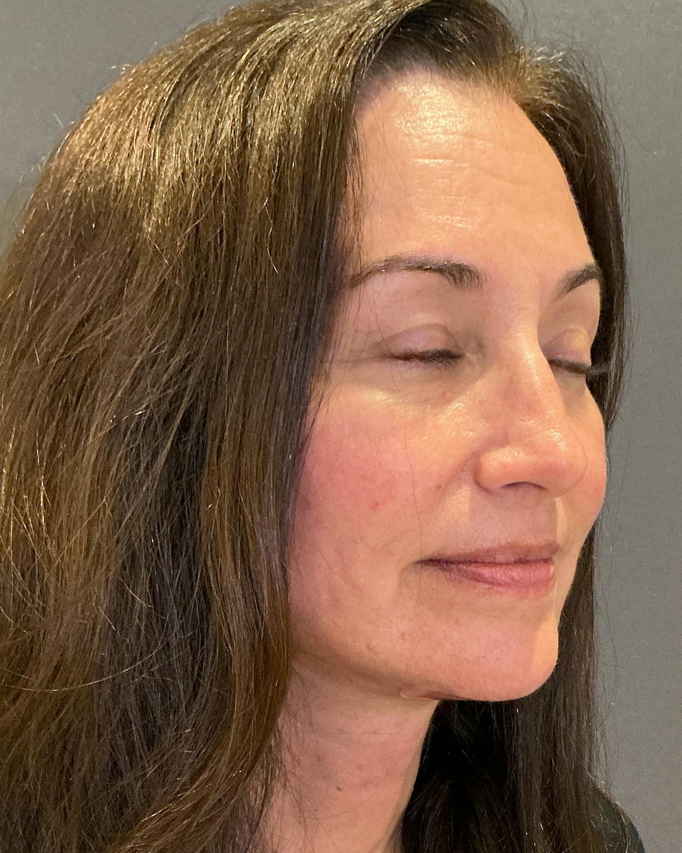 Facelifts / Necklift Before & After Gallery - Patient 163098 - Image 2