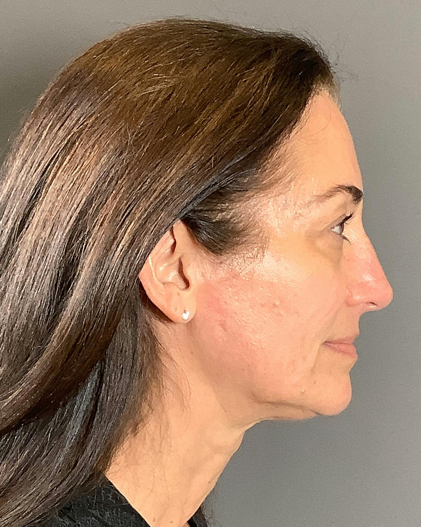 Facelifts / Necklift Before & After Gallery - Patient 163098 - Image 3