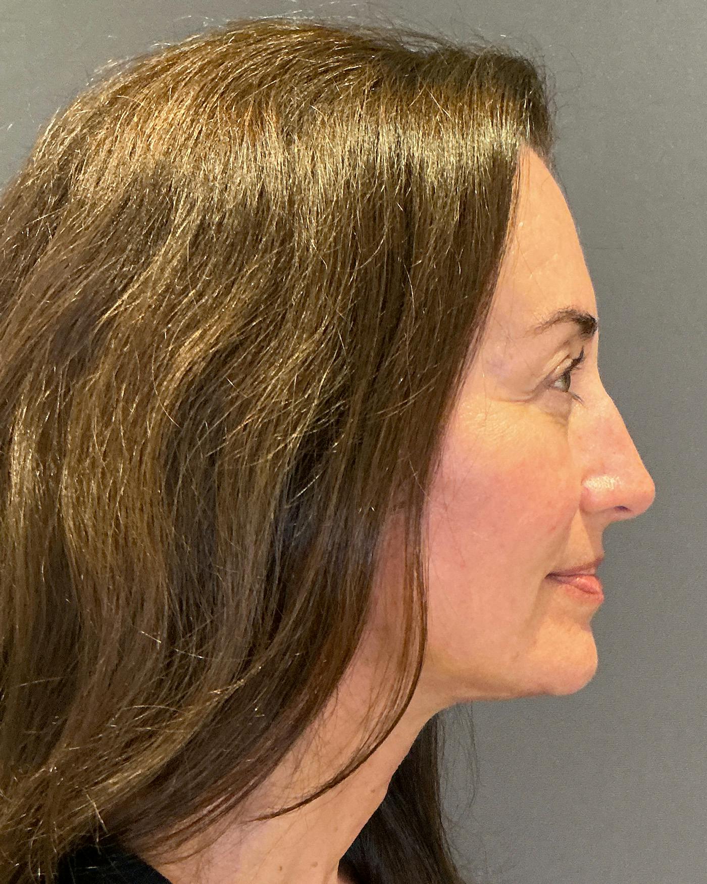 Facelifts / Necklift Before & After Gallery - Patient 163098 - Image 4