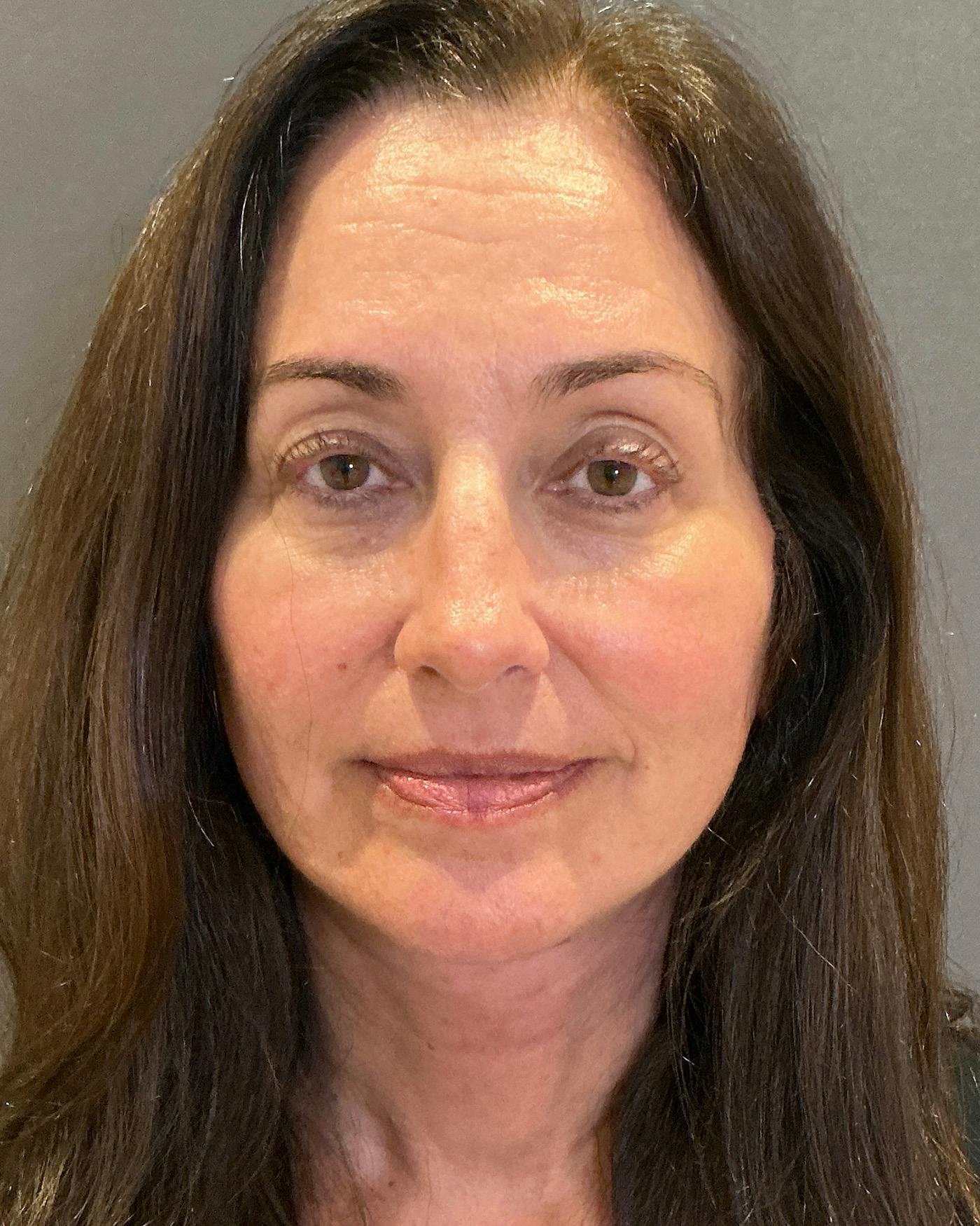 Facelifts / Necklift Before & After Gallery - Patient 163098 - Image 6