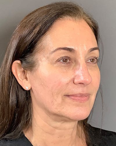 Facelifts / Necklift Before & After Gallery - Patient 163098 - Image 1