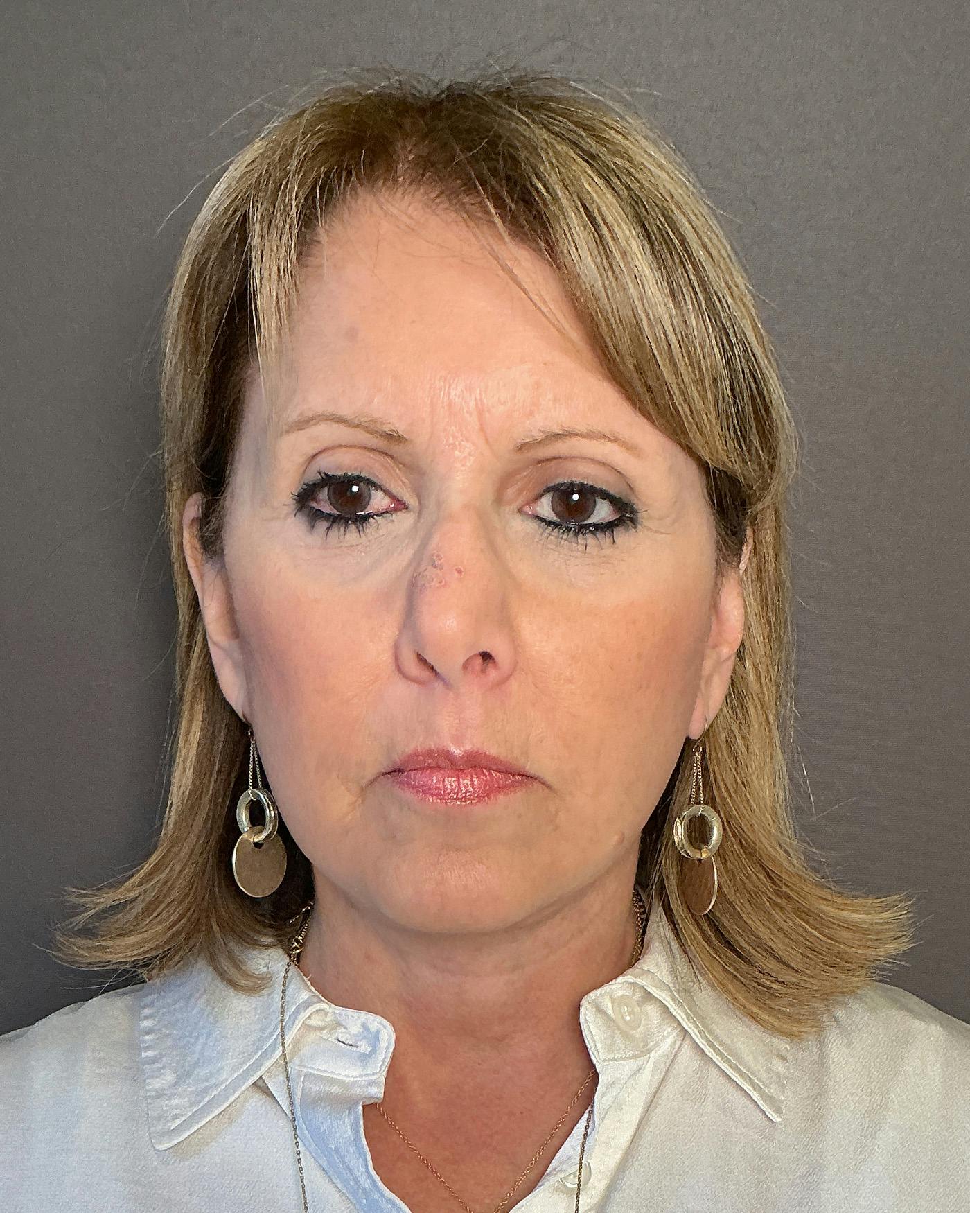 Facial Fat Transfer Before & After Gallery - Patient 174103 - Image 2