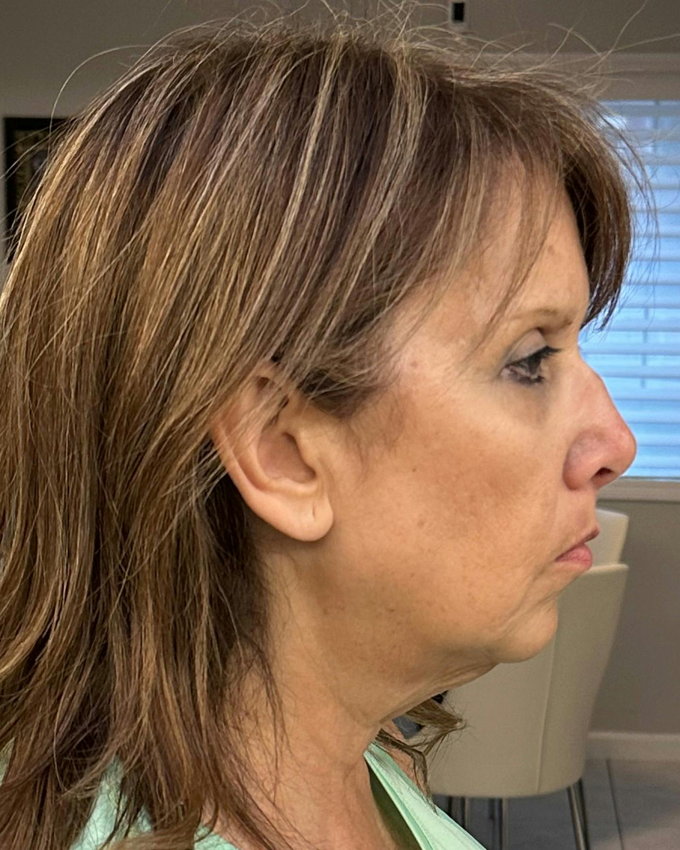 Facial Fat Transfer Before & After Gallery - Patient 174103 - Image 3