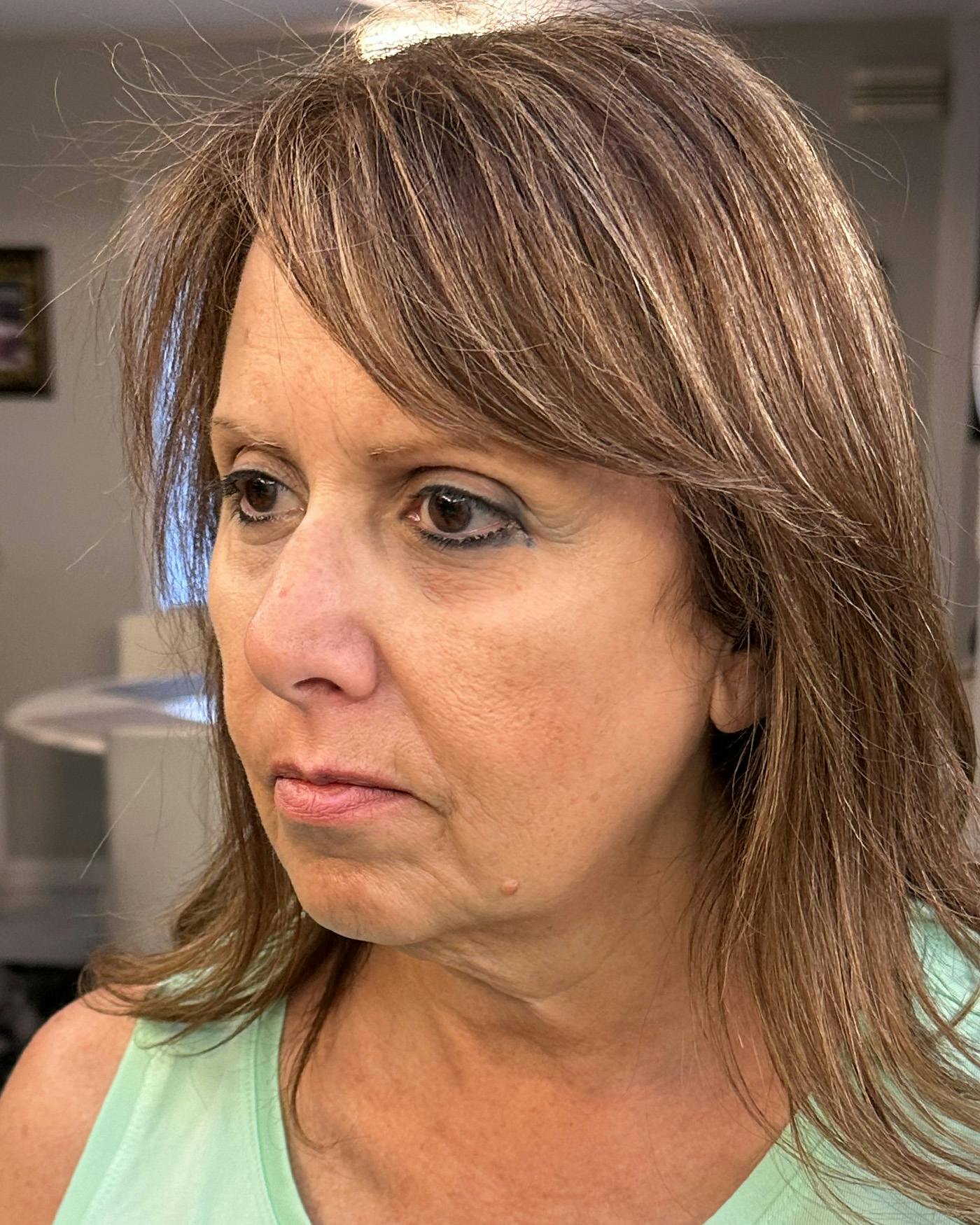 Facial Fat Transfer Before & After Gallery - Patient 174103 - Image 5