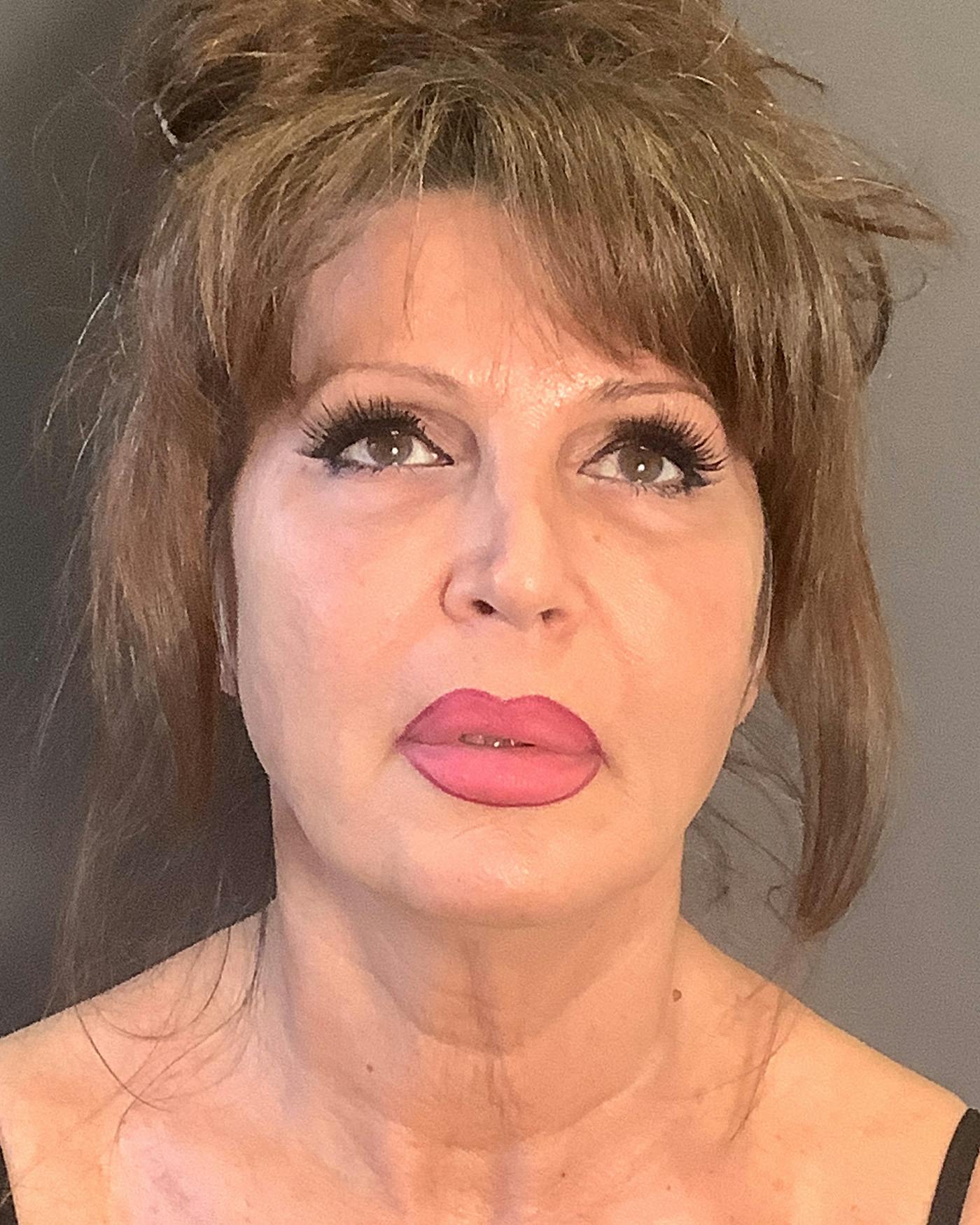 Revision Rhinoplasty Before & After Gallery - Patient 245151 - Image 3