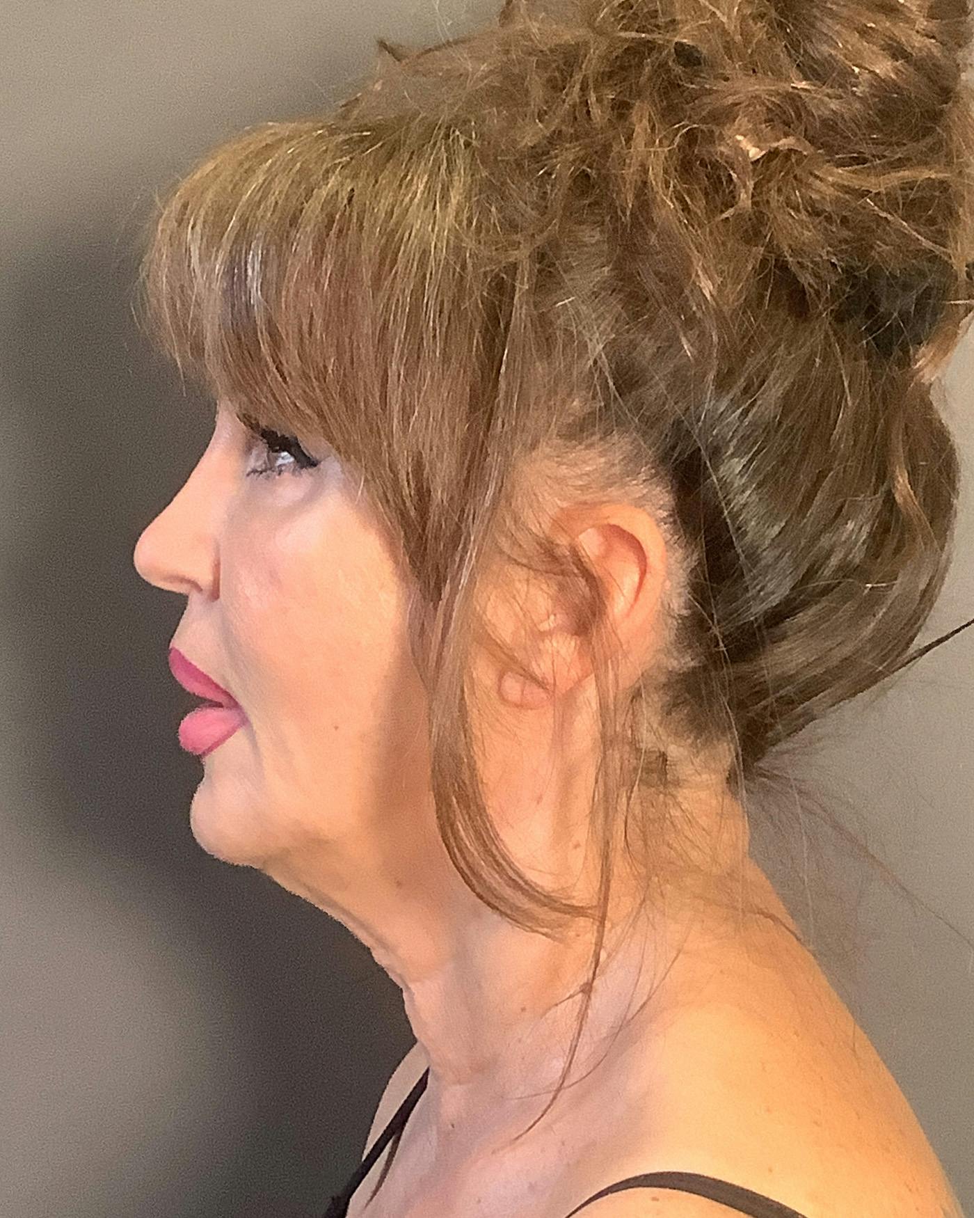 Revision Rhinoplasty Before & After Gallery - Patient 245151 - Image 7