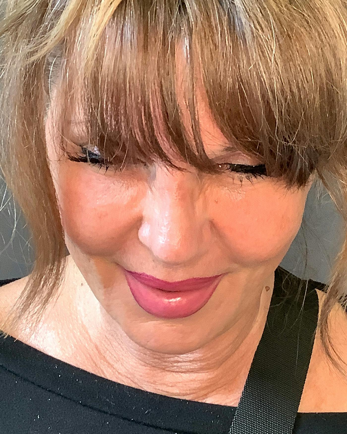 Revision Rhinoplasty Before & After Gallery - Patient 245151 - Image 10