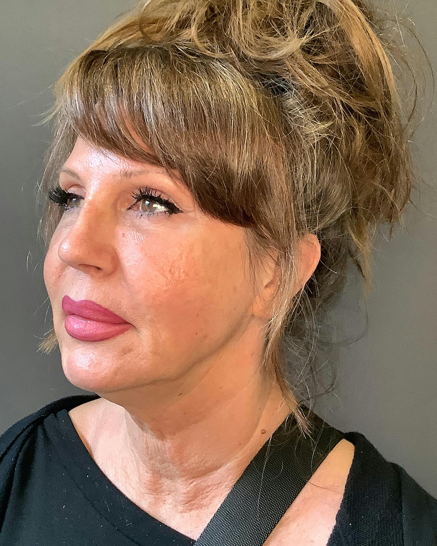 Revision Rhinoplasty Before & After Gallery - Patient 245151 - Image 6