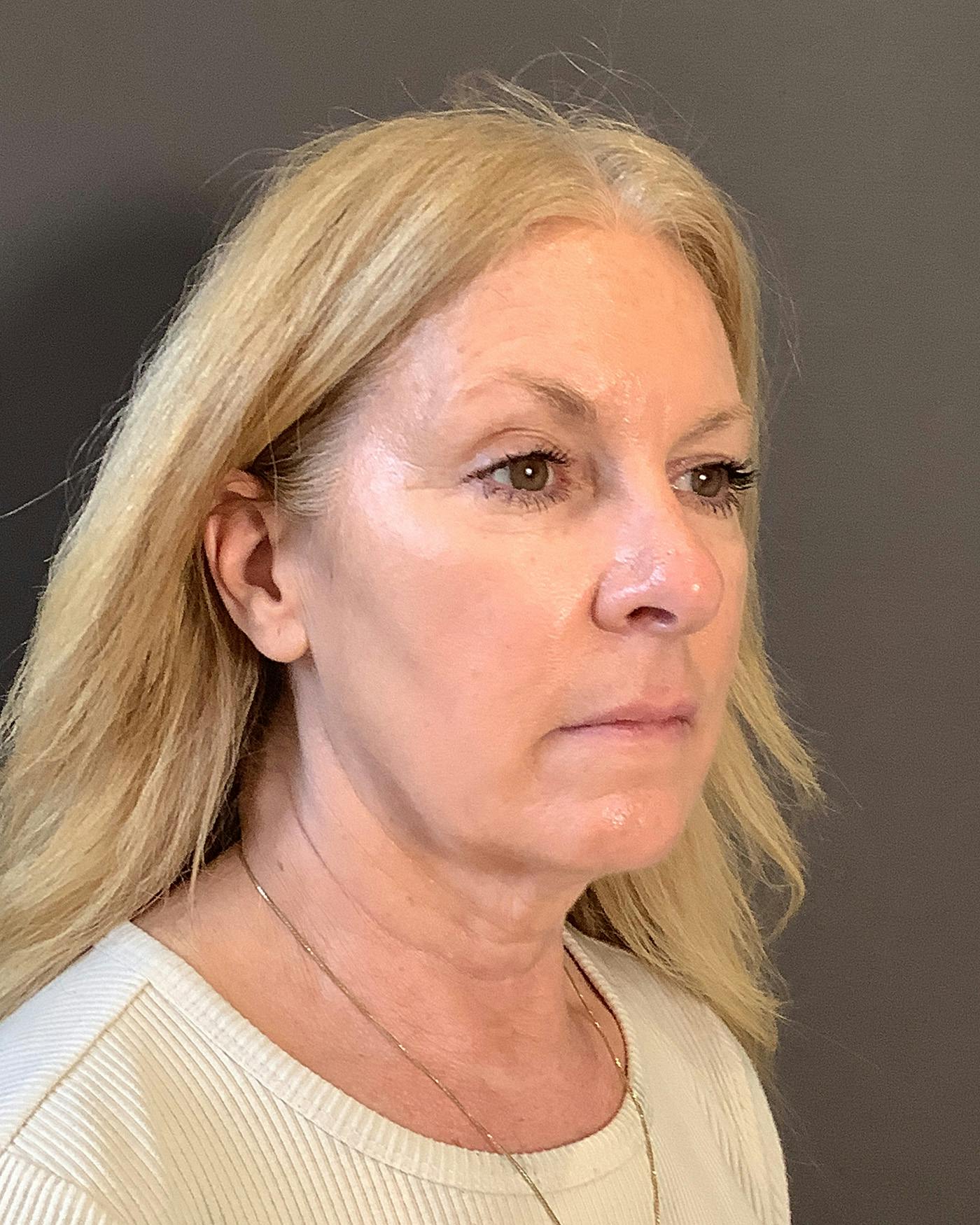 CO2 Full Face Before & After Gallery - Patient 407428 - Image 3