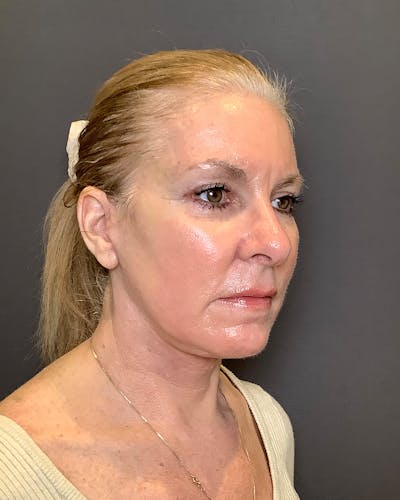 Facelifts / Necklift Before & After Gallery - Patient 422649 - Image 2