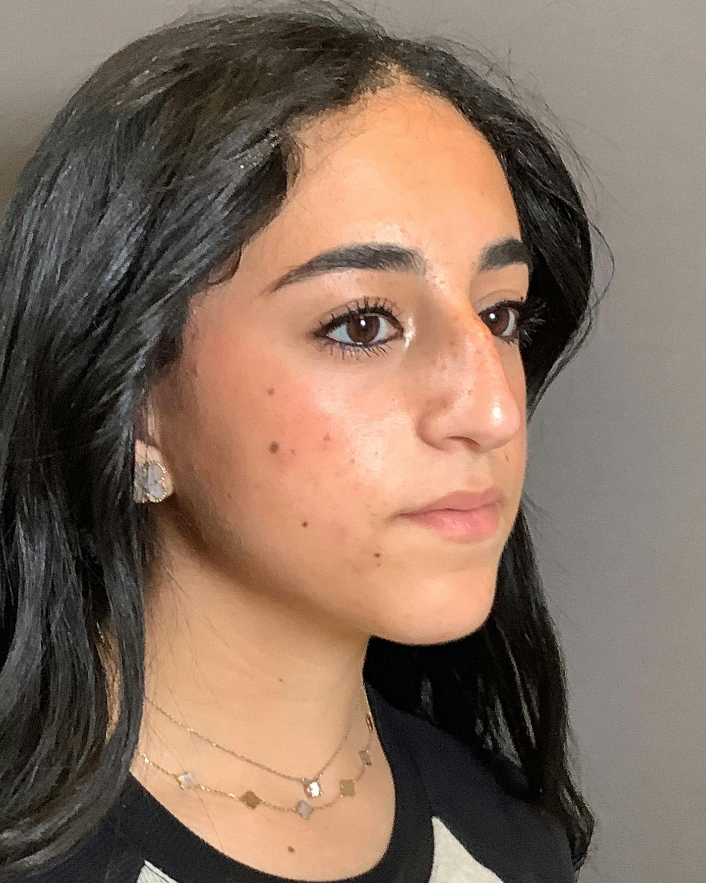 Rhinoplasty Before & After Gallery - Patient 192754 - Image 3