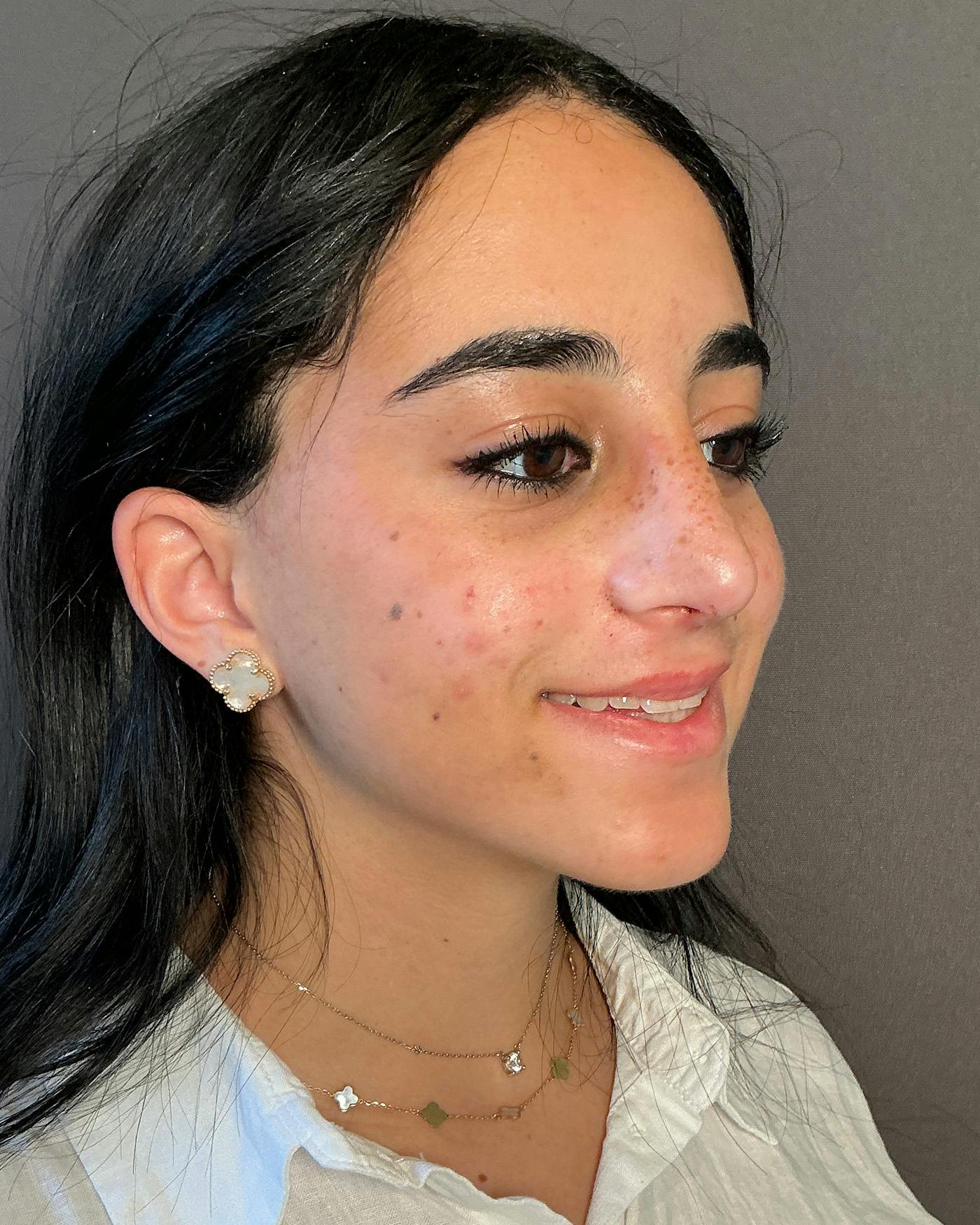 Rhinoplasty Before & After Gallery - Patient 192754 - Image 4
