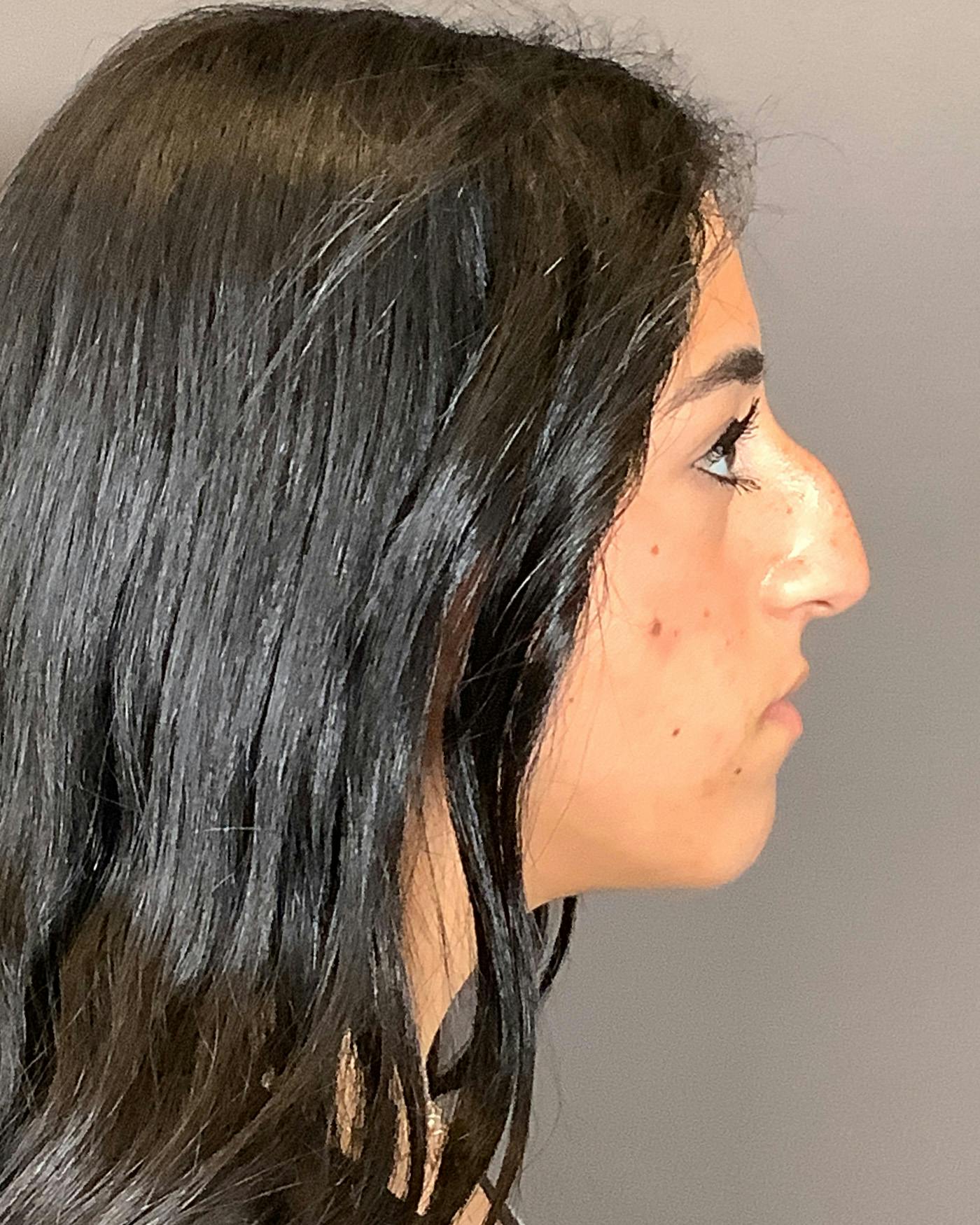 Rhinoplasty Before & After Gallery - Patient 192754 - Image 1