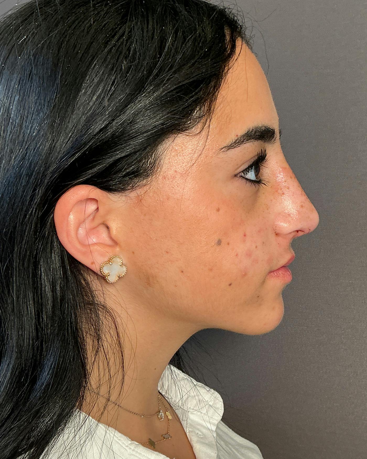 Rhinoplasty Before & After Gallery - Patient 192754 - Image 2