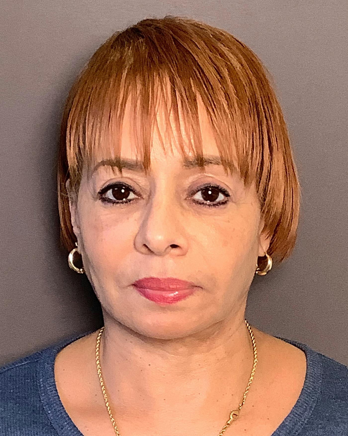 Facial Fat Transfer Before & After Gallery - Patient 256345 - Image 1