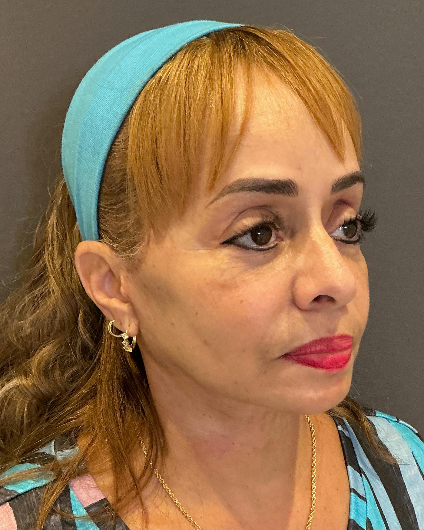Facial Fat Transfer Before & After Gallery - Patient 256345 - Image 4