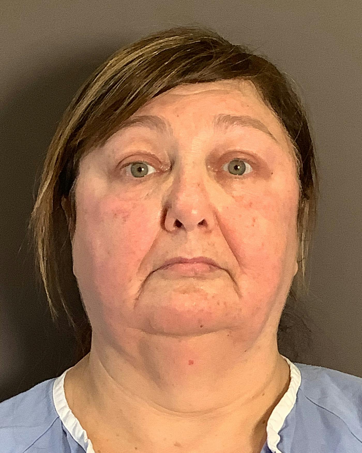Facelifts / Necklift Before & After Gallery - Patient 458686 - Image 5