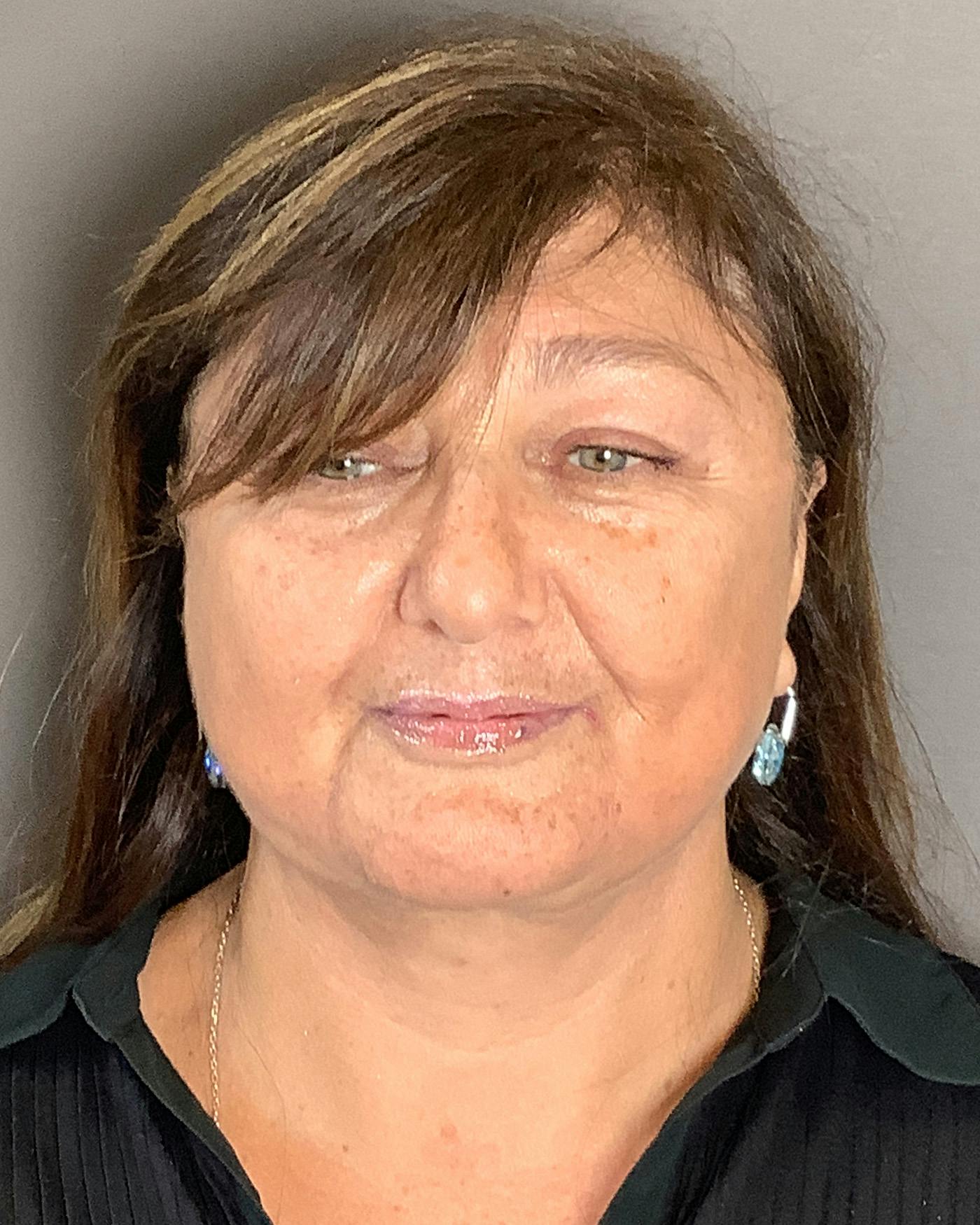 Facelifts / Necklift Before & After Gallery - Patient 458686 - Image 6