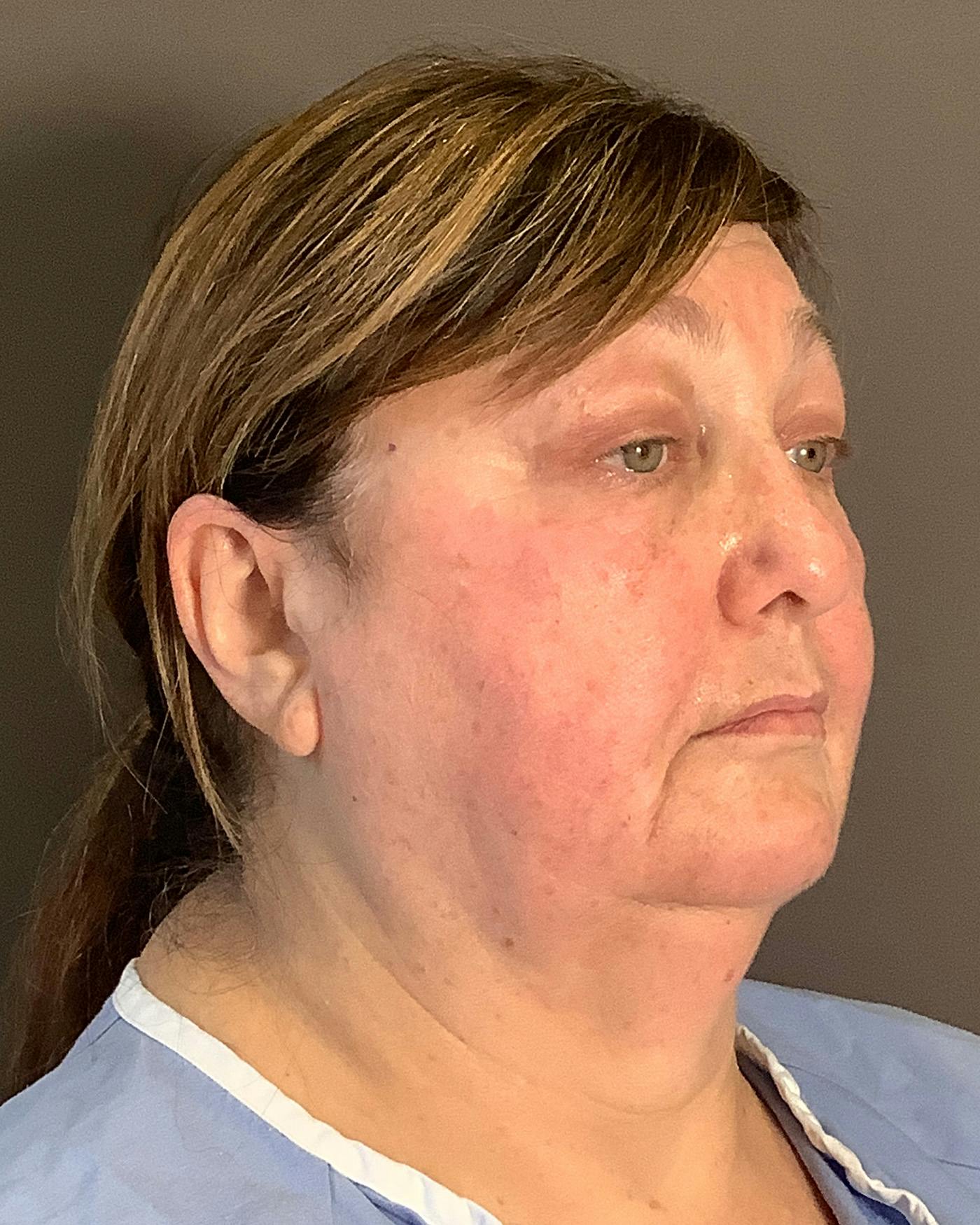 Facelifts / Necklift Before & After Gallery - Patient 458686 - Image 1