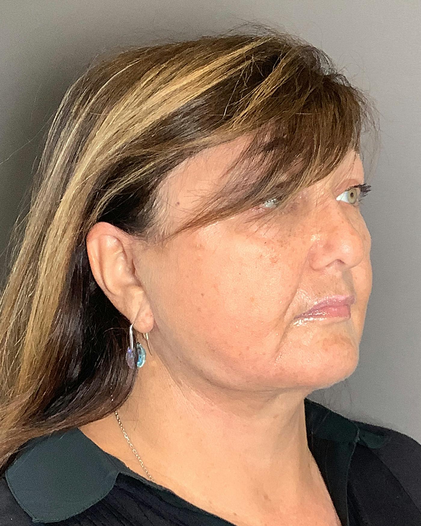 Facelifts / Necklift Before & After Gallery - Patient 458686 - Image 2