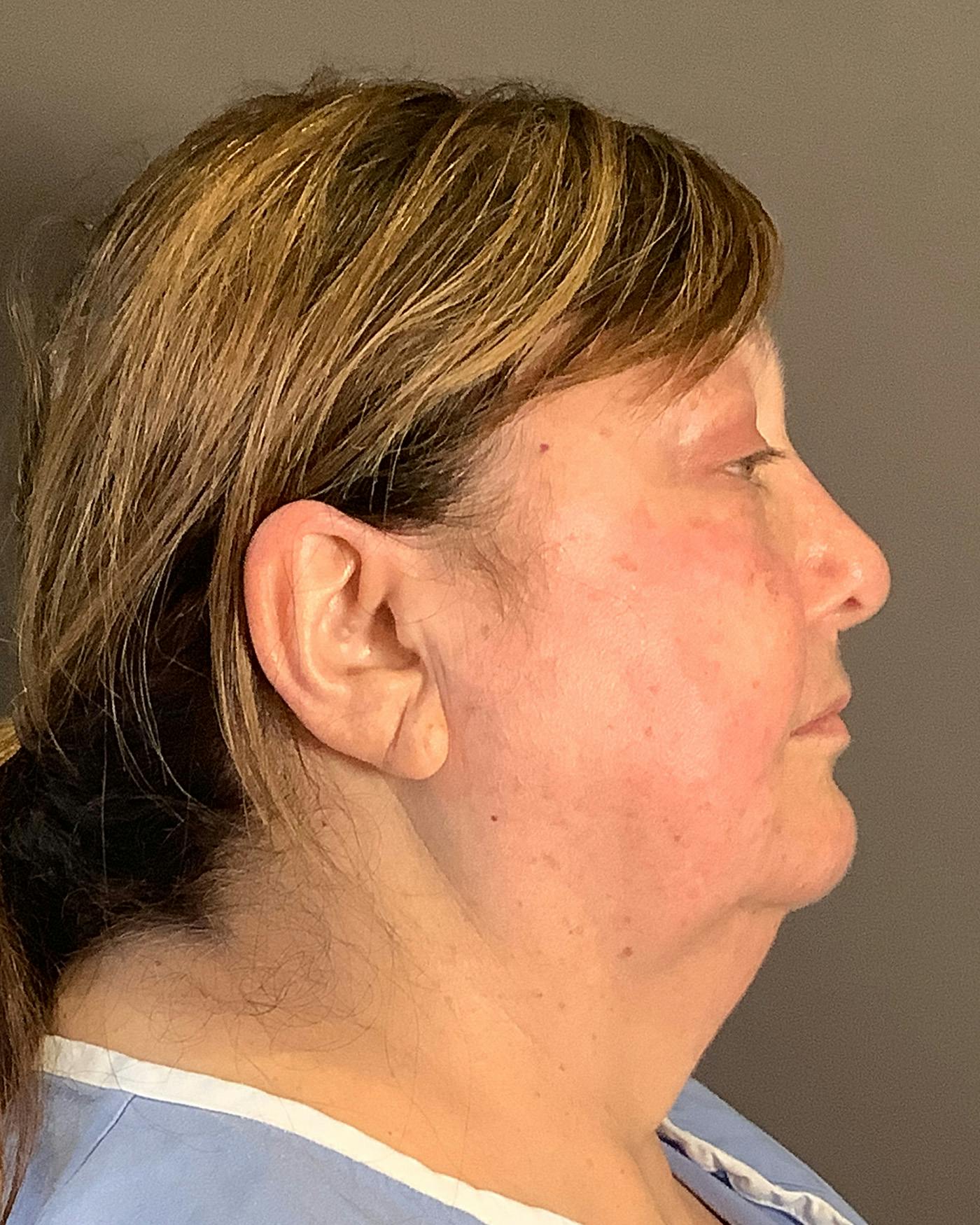 Facelifts / Necklift Before & After Gallery - Patient 458686 - Image 3