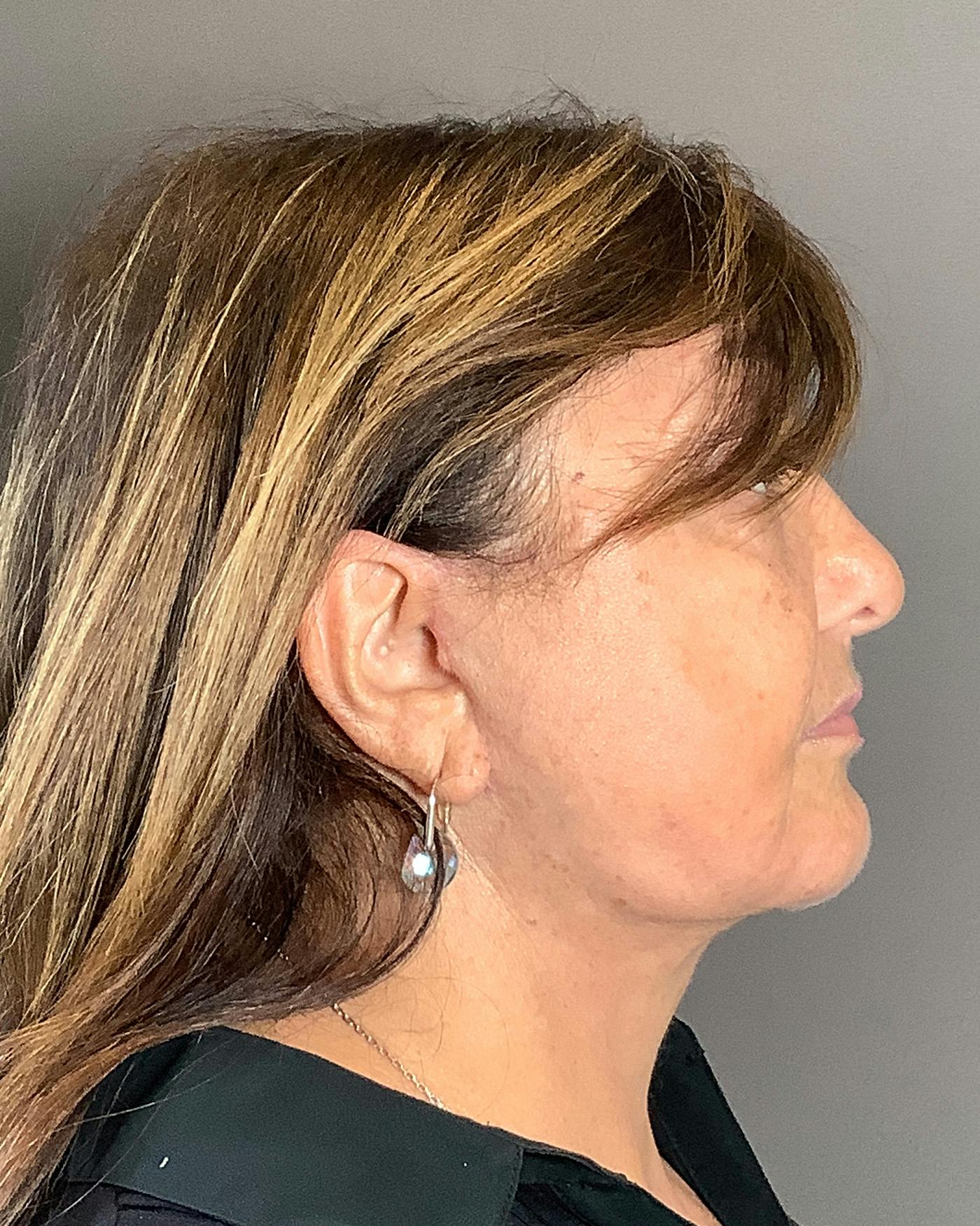 Facelifts / Necklift Before & After Gallery - Patient 458686 - Image 4