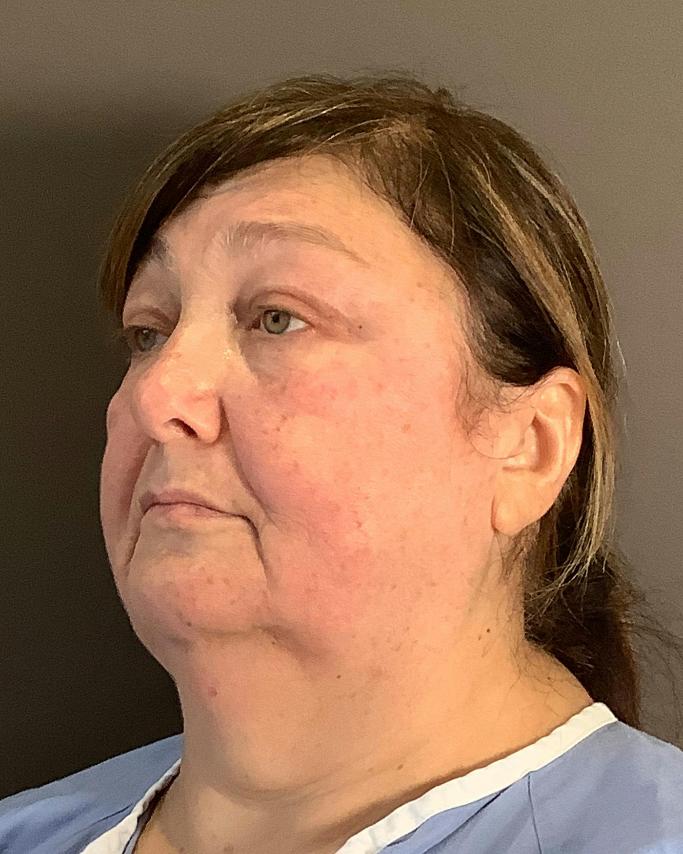 Facelifts / Necklift Before & After Gallery - Patient 458686 - Image 7