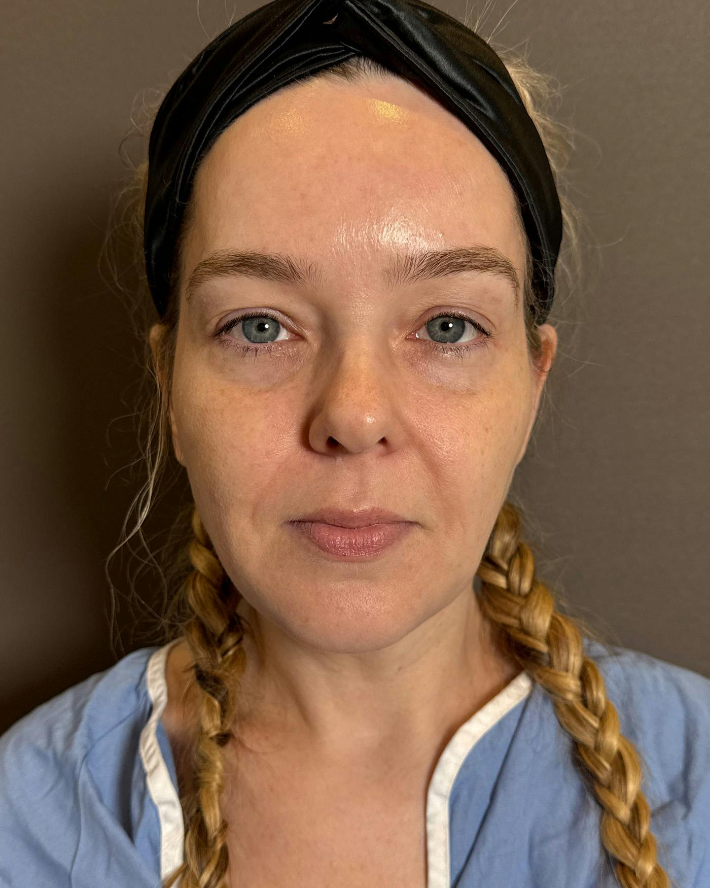 Facelifts / Necklift Before & After Gallery - Patient 191782 - Image 5