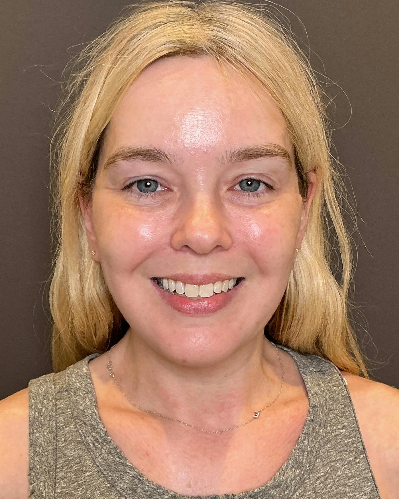 Facelifts / Necklift Before & After Gallery - Patient 191782 - Image 6
