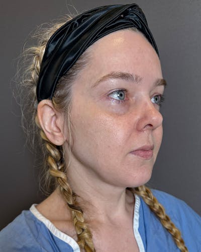 Facelifts / Necklift Before & After Gallery - Patient 191782 - Image 1