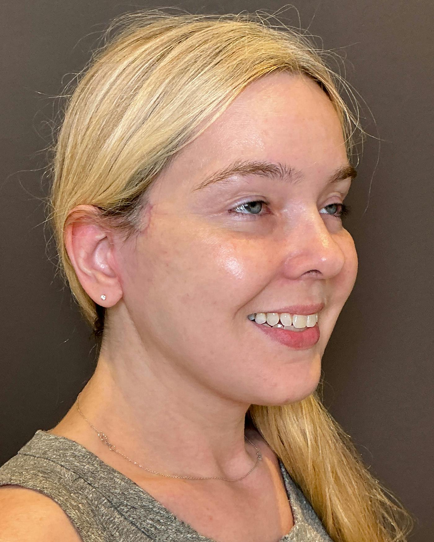 Facelifts / Necklift Before & After Gallery - Patient 191782 - Image 2