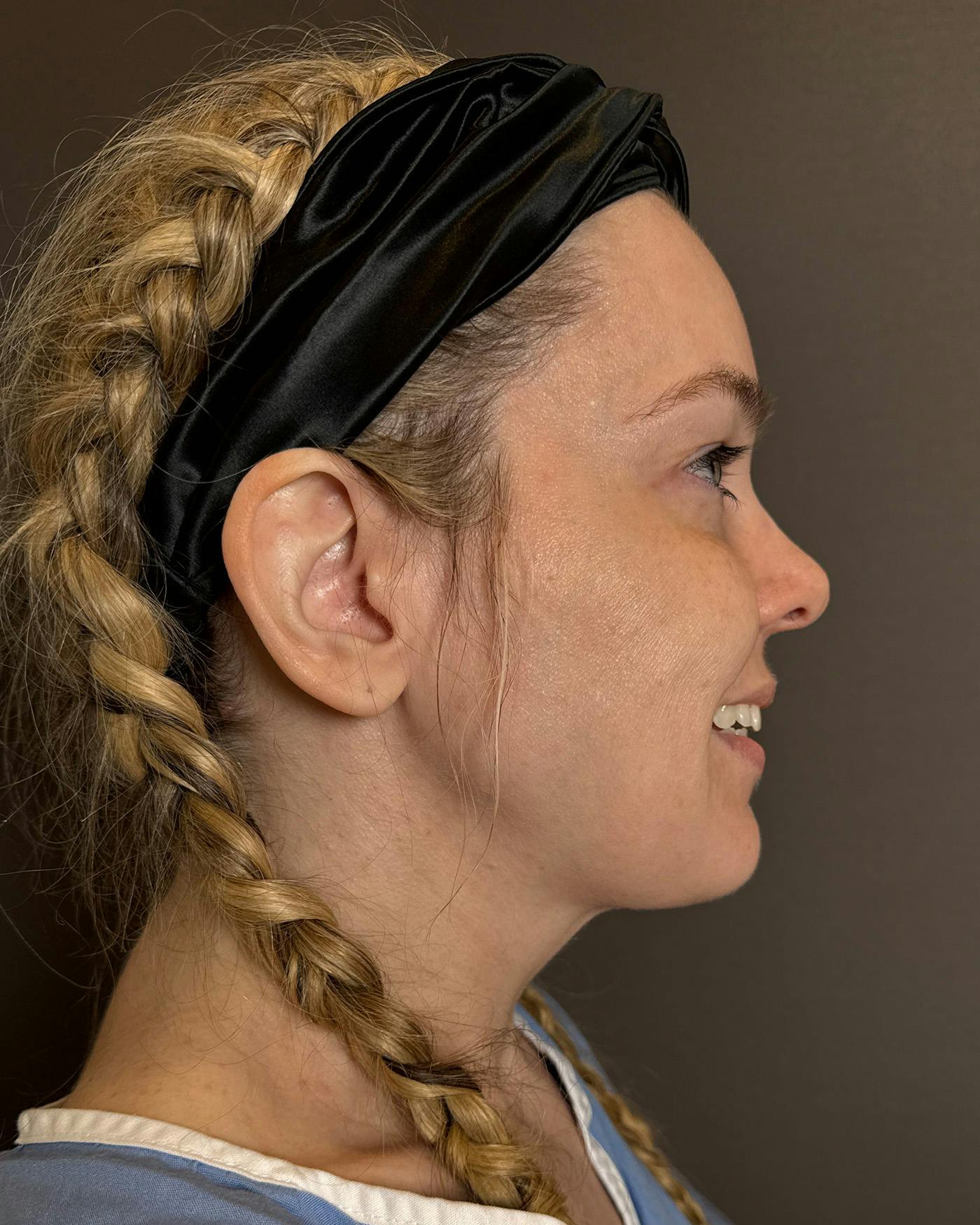 Facelifts / Necklift Before & After Gallery - Patient 191782 - Image 3