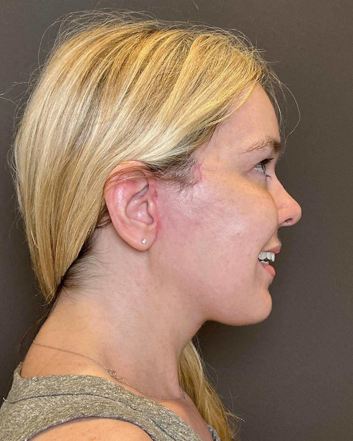 Facelifts / Necklift Before & After Gallery - Patient 191782 - Image 4