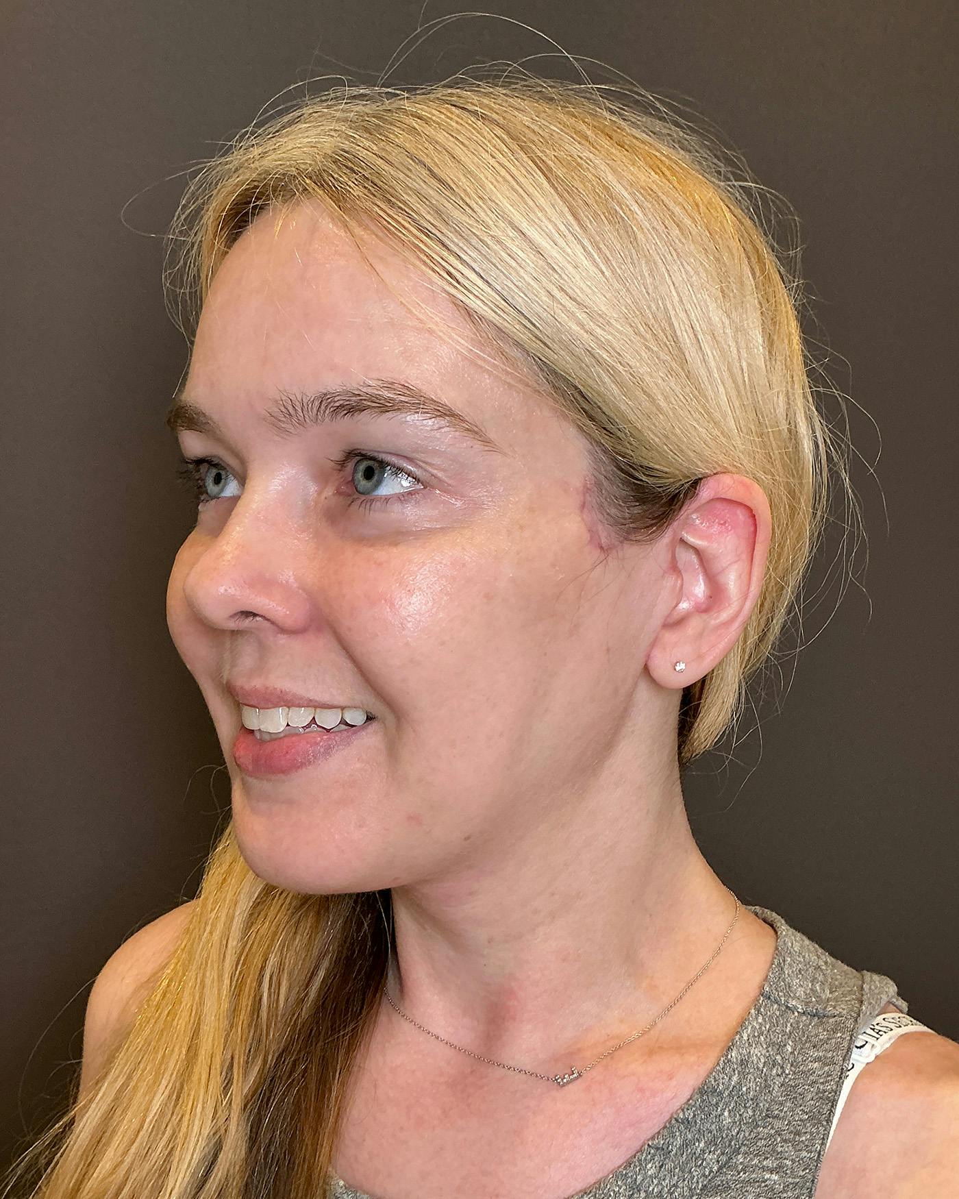 Facelifts / Necklift Before & After Gallery - Patient 191782 - Image 8