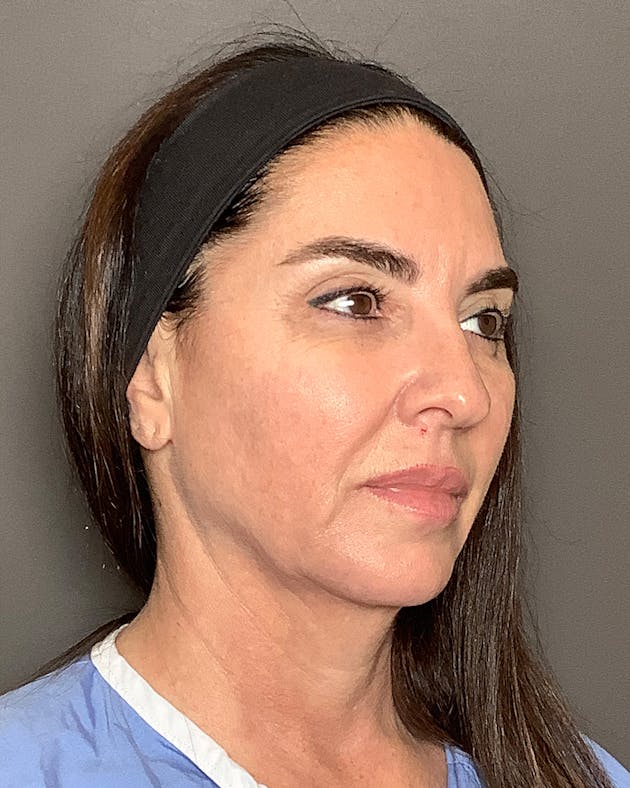 Facelift & Necklift before in NYC, patient 283733