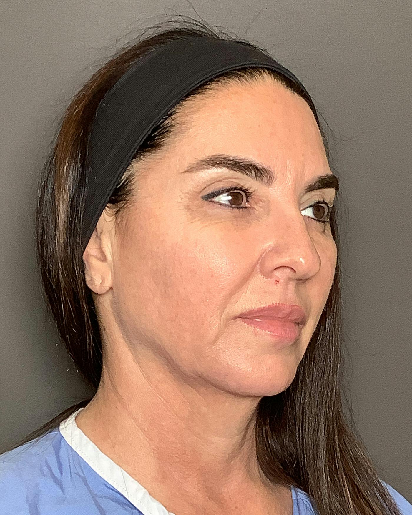 Facial Fat Transfer Before & After Gallery - Patient 250454 - Image 3