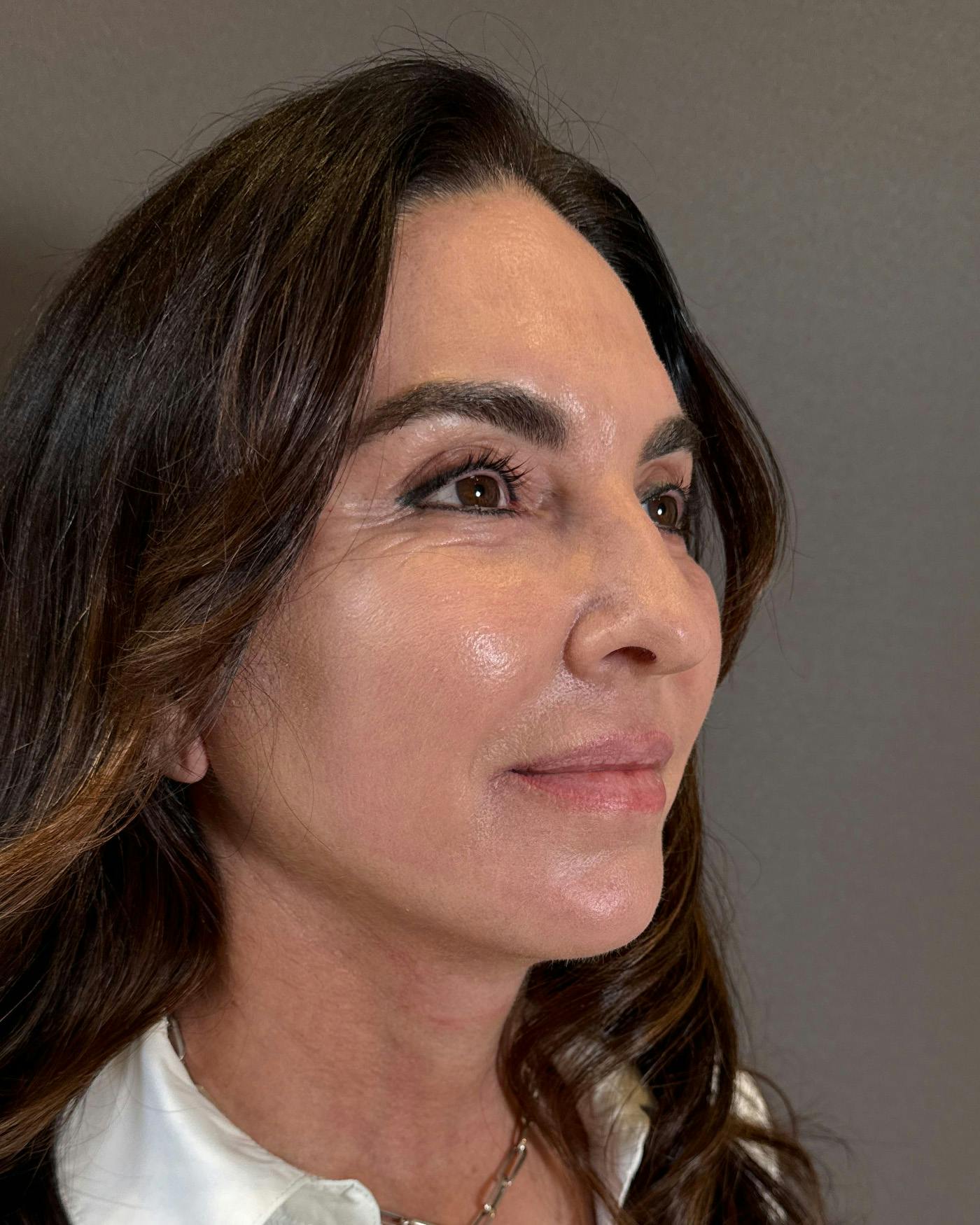 Facial Fat Transfer Before & After Gallery - Patient 250454 - Image 4