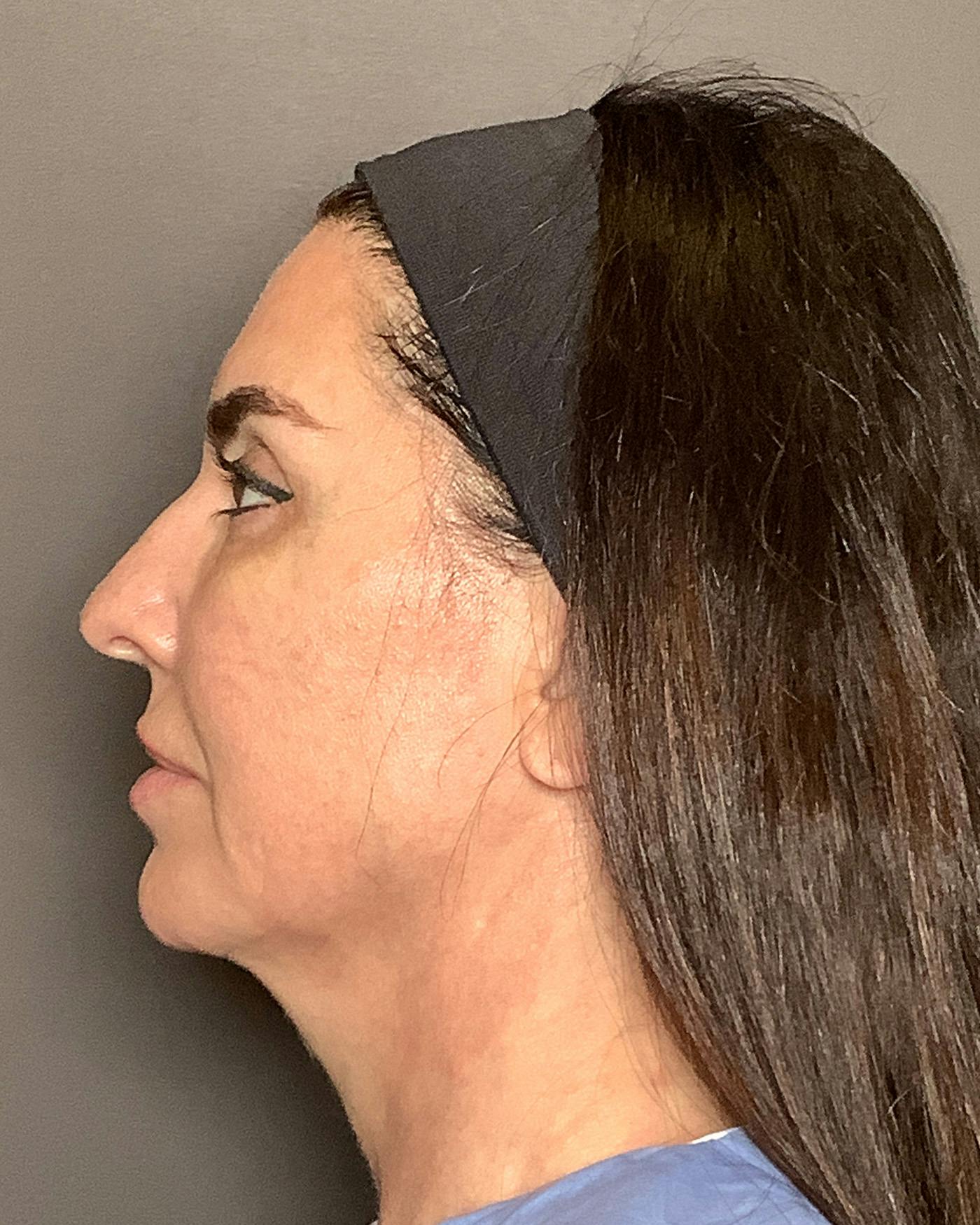 Facial Fat Transfer Before & After Gallery - Patient 250454 - Image 9