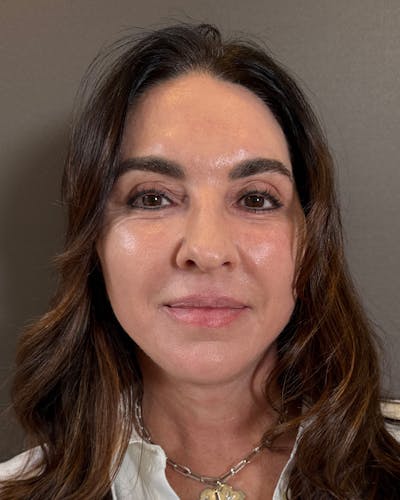 CO2 Full Face Before & After Gallery - Patient 458833 - Image 2