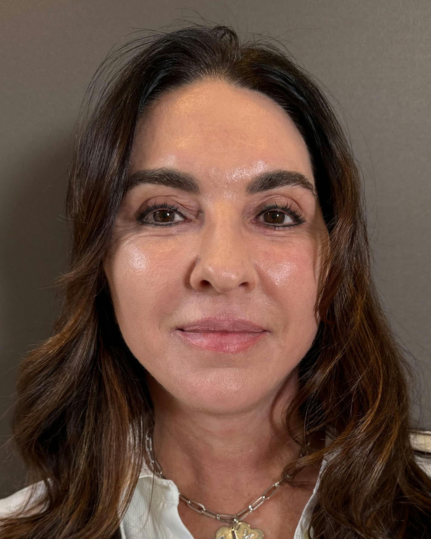 Facial Fat Transfer Before & After Gallery - Patient 250454 - Image 2