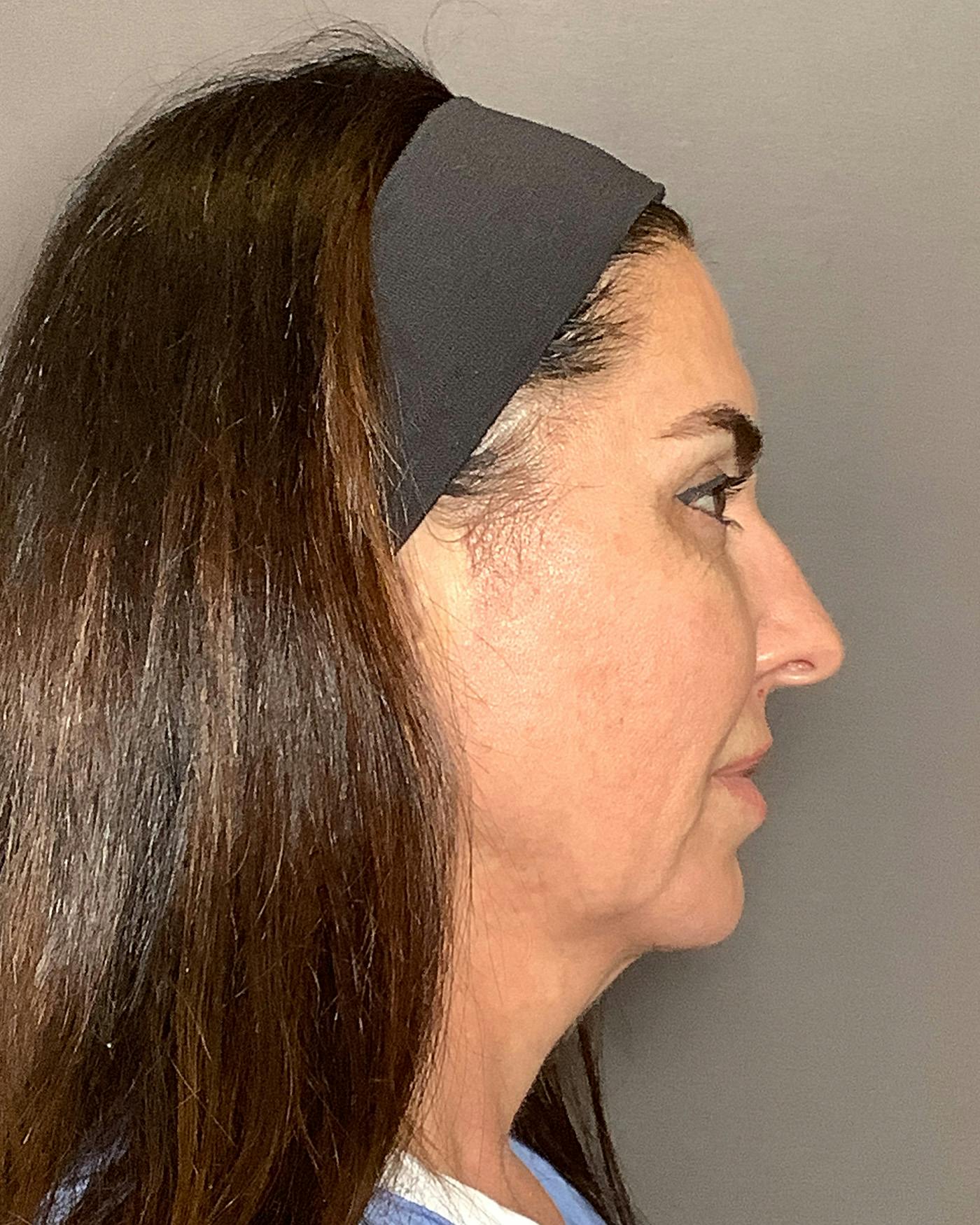 Facial Fat Transfer Before & After Gallery - Patient 250454 - Image 5