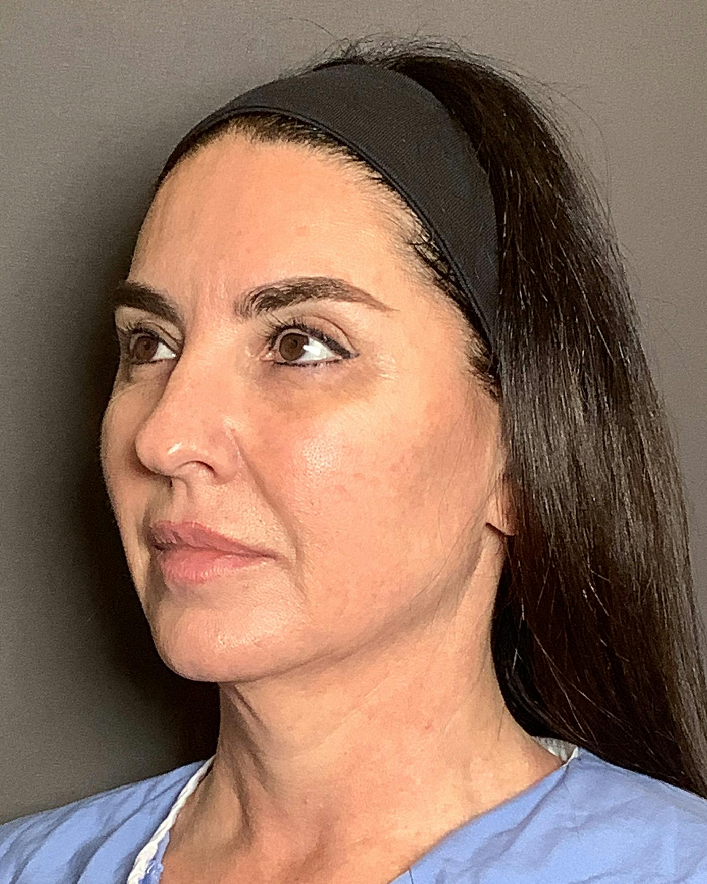 Facial Fat Transfer Before & After Gallery - Patient 250454 - Image 7