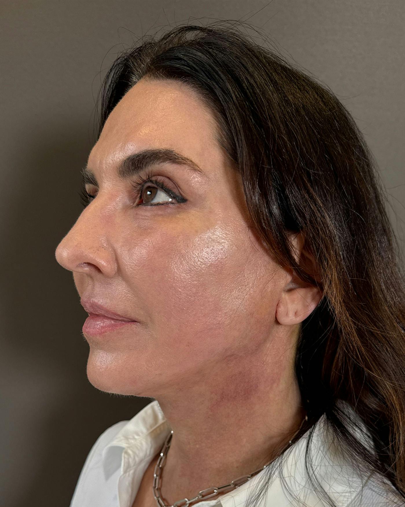 Facial Fat Transfer Before & After Gallery - Patient 250454 - Image 8