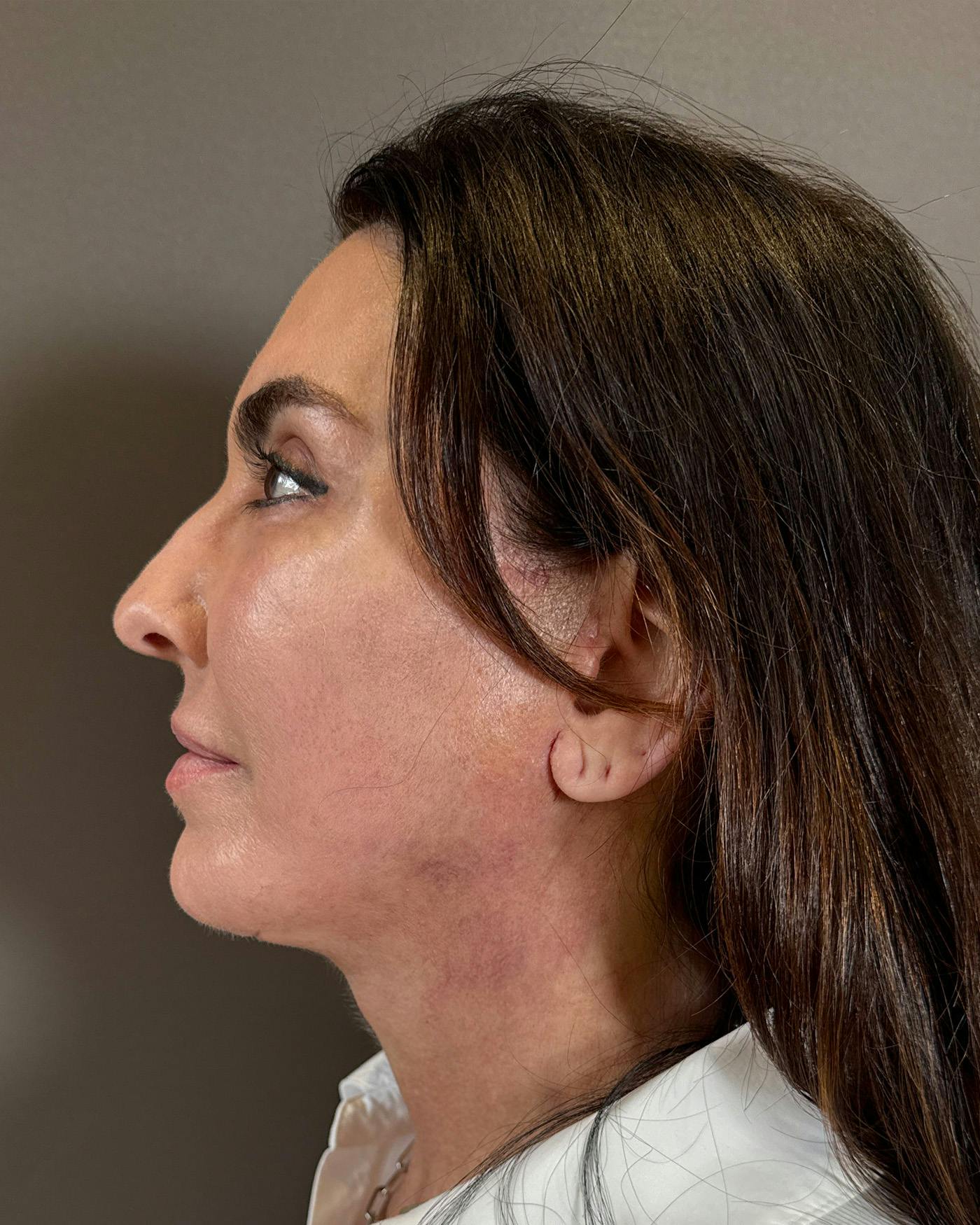 Facial Fat Transfer Before & After Gallery - Patient 250454 - Image 10