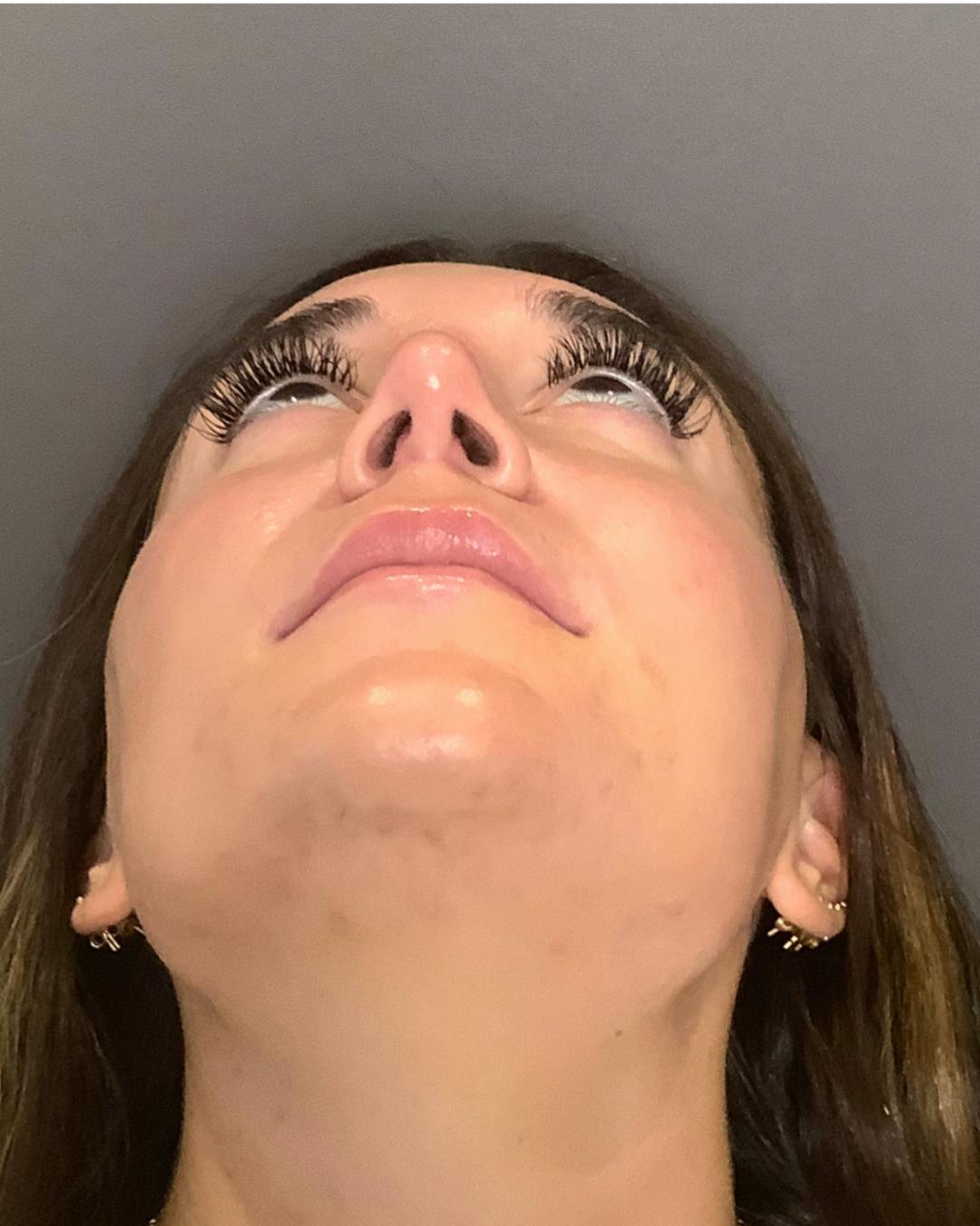 Rhinoplasty Before & After Gallery - Patient 140797 - Image 10