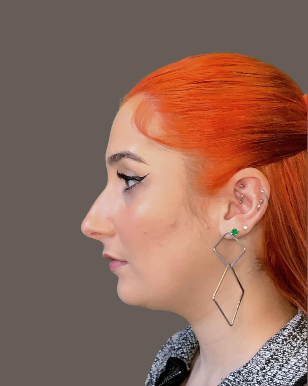 Rhinoplasty Before & After Gallery - Patient 143120 - Image 9