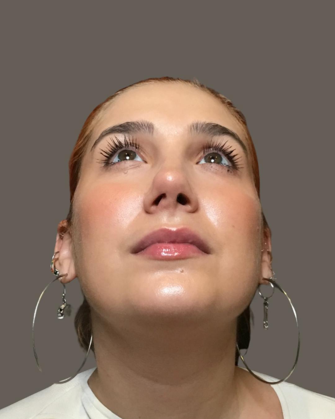 Rhinoplasty Before & After Gallery - Patient 143120 - Image 14