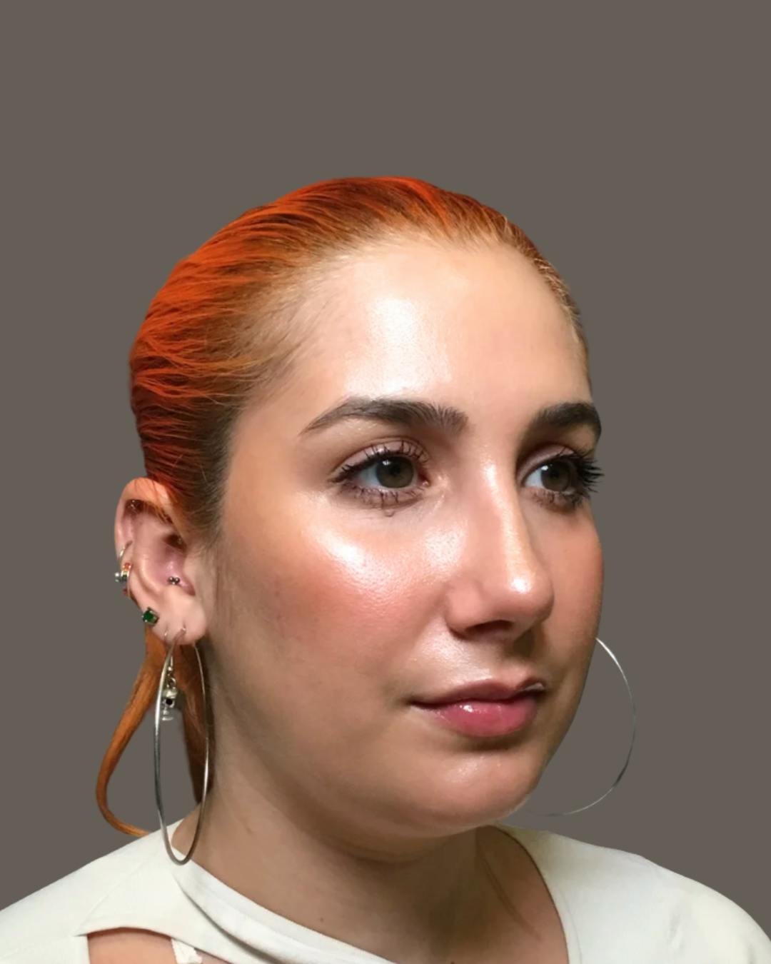 Rhinoplasty Before & After Gallery - Patient 143120 - Image 4