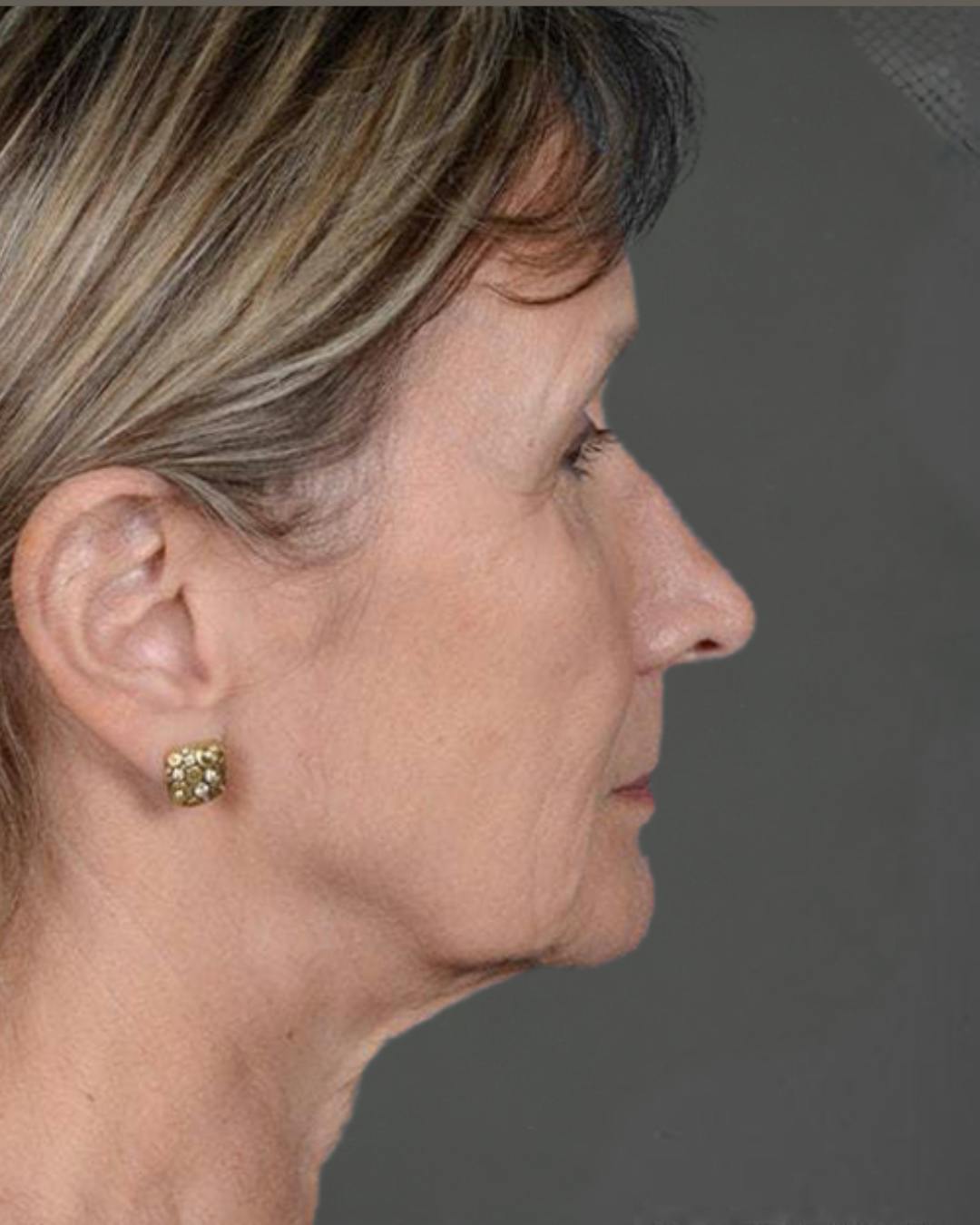 Facelifts / Necklift Before & After Gallery - Patient 151452110 - Image 3