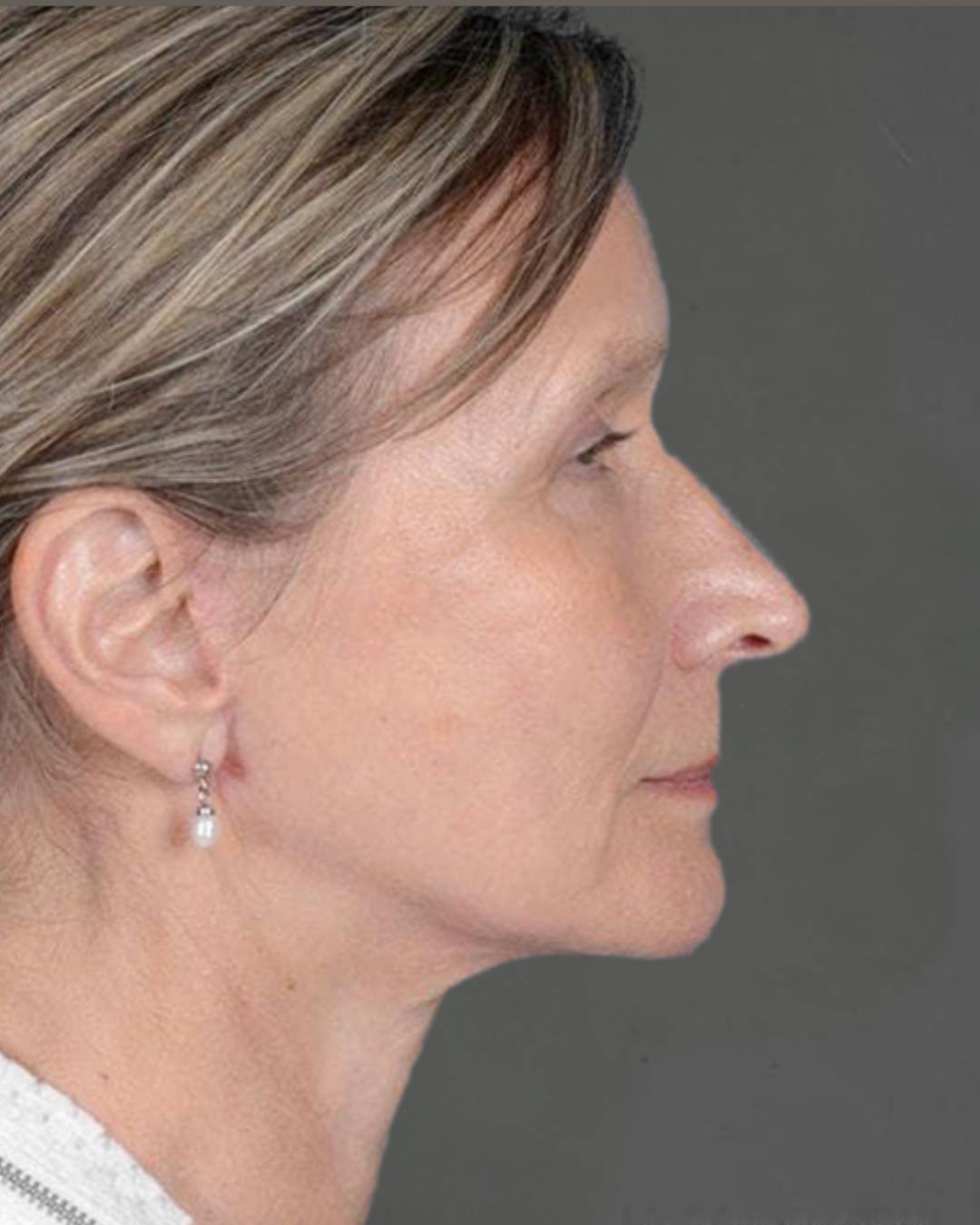 Facelifts / Necklift Before & After Gallery - Patient 151452110 - Image 4